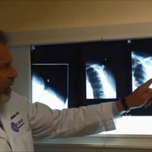 Exactech: Acute Reverse for Proximal Humerus Fracture with Joseph Zuckerman, MD - 718-02-34